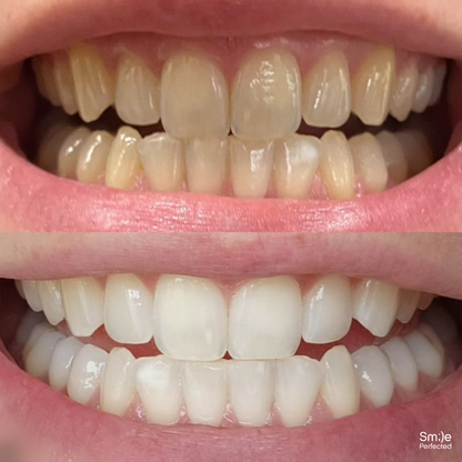 Smile Perfected™ Complete In-Office System